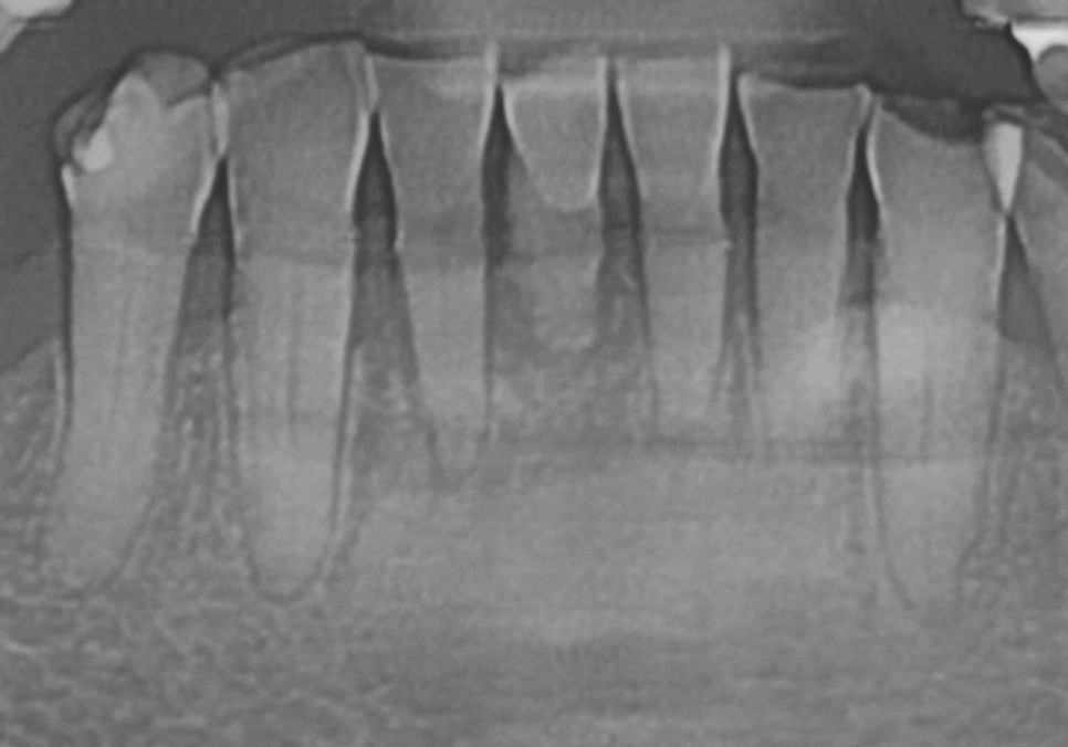 뿌리만 남은 치아, 그대로 두면 왜 위험할까요? 고덕동 전체 임플란트 재건 사례 관련 이미지 10