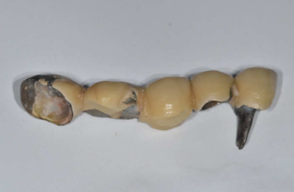 오래된 어금니 롱브릿지, 교체 타이밍을 놓치면 관련 이미지 1