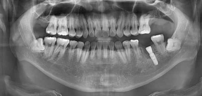 감일동 치과 첫번째 임플란트 시작이 중요합니다. 관련 이미지 7