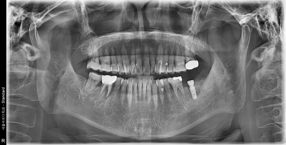 바르디 임플란트는 바르게 심지만, 빠르게 씹습니다. 그간의 경험을 바탕으로요. 관련 이미지 8