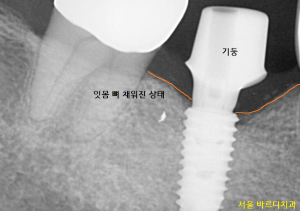 풍산동 치과 임플란트 염증으로 교체 한 환자분 케이스 관련 이미지 7