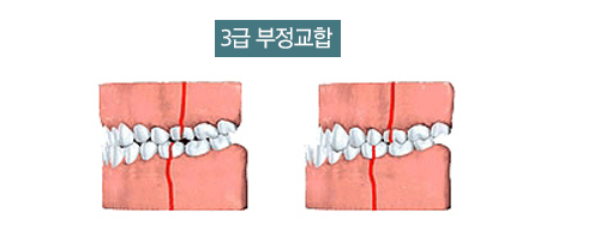 고덕역 교정치과 성인 부정교합 위아래가 거꾸로 물릴때는? 관련 이미지 4