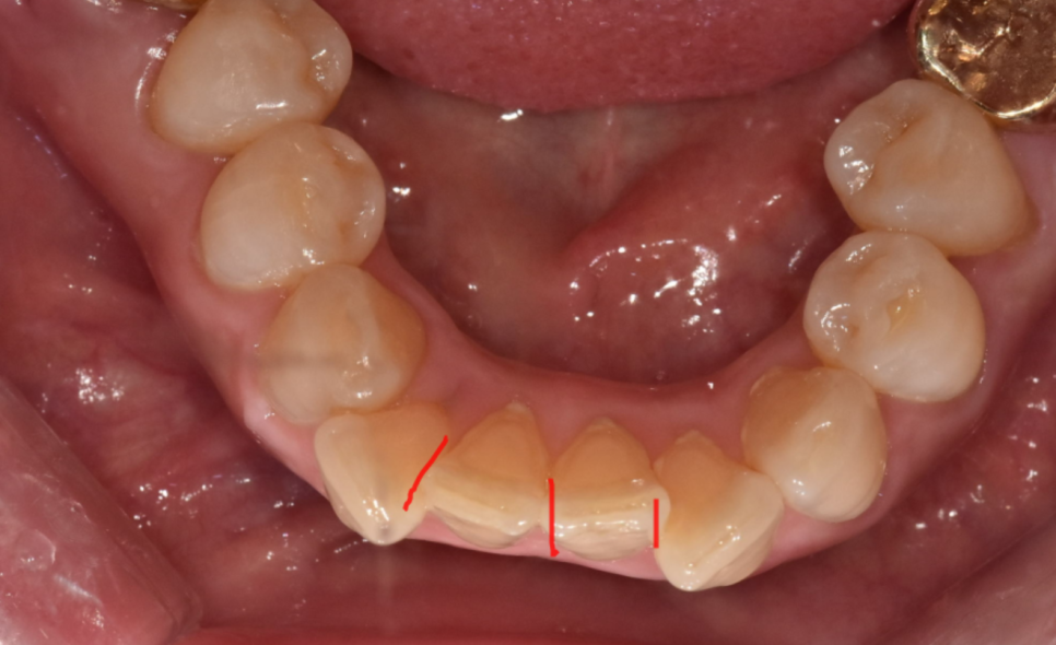 The Moment You Decide on Orthodontic Treatment in Your 50s Is the Fastest image 1