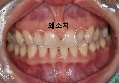 고덕동 무삭제 라미네이트, 실패 없이 하려면 꼭 확인할 3가지 관련 이미지 2
