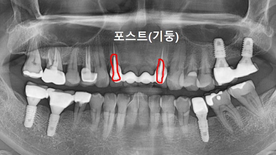 명일동 앞니 브릿지, 새로 교체 할 때 꼭 확인해 봐야 할 관련 이미지 3