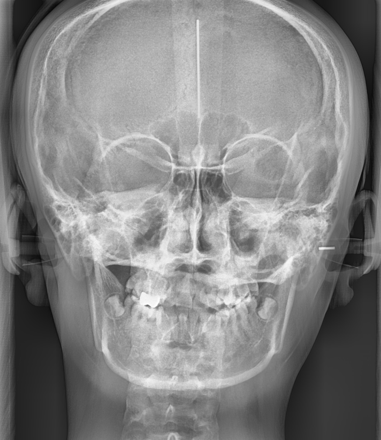 이 안뽑고 교정 안되나요? 발치 교정 케이스를 정리합니다! 관련 이미지 7