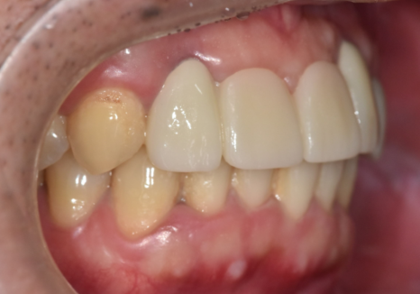 앞니 브릿지 부러짐, 이런 상태라면 절대 브릿지 다시 하지 마세요. 관련 이미지 16