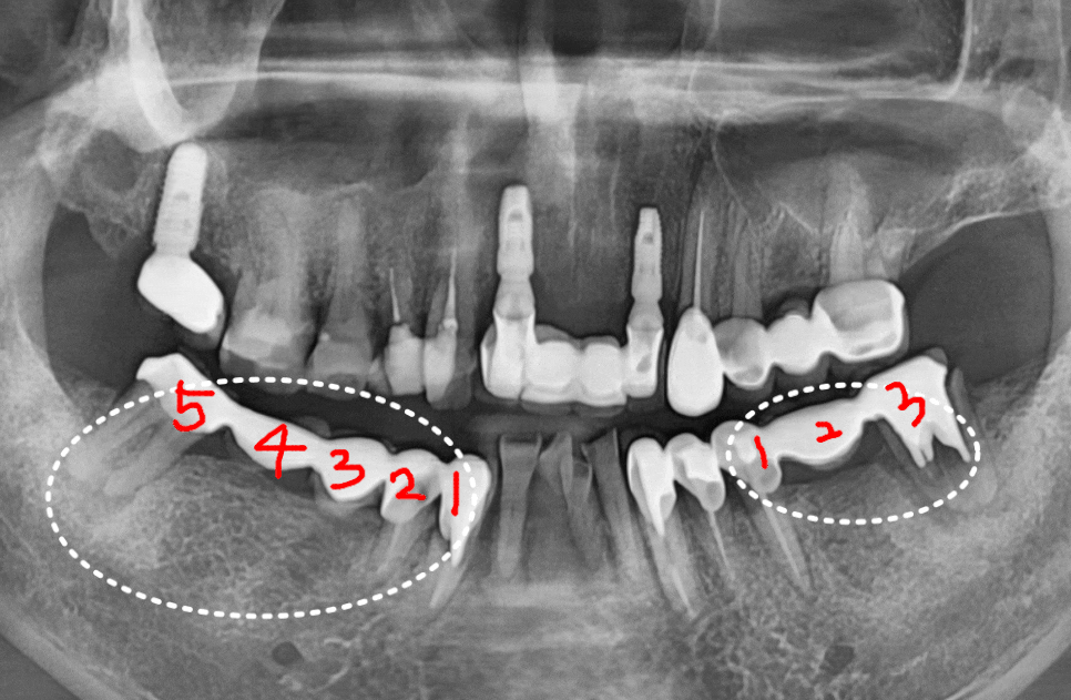 오래된 어금니 롱브릿지, 교체 타이밍을 놓치면 관련 이미지 18