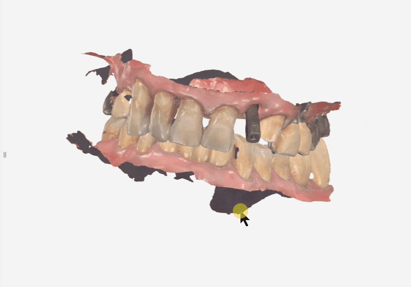 대문니 빠짐, 앞니 빠졌을 때 브릿지와 임플란트 중 나에게 맞는 선택은? 관련 이미지 13