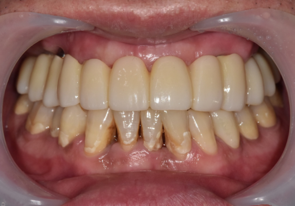 위 턱 전체 임플란트 vs 부분 틀니, 나에게 꼭 필요한 치료법 찾기 관련 이미지 16