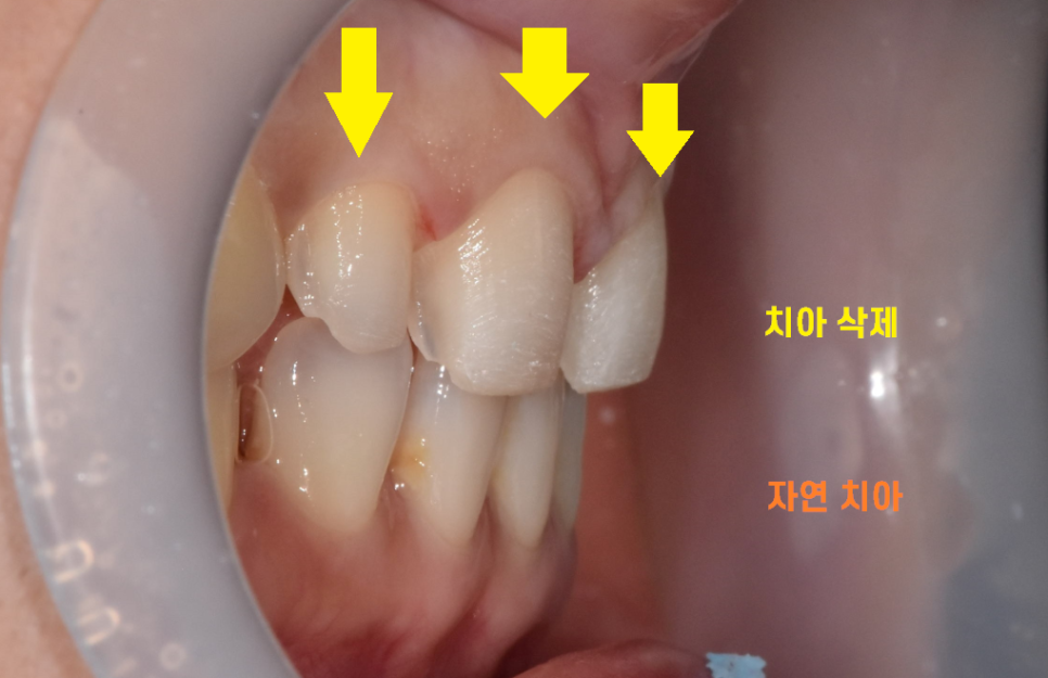 왜소치 라미네이트 작은 치아 콤플렉스 말끔하게 극복해요!! 관련 이미지 6