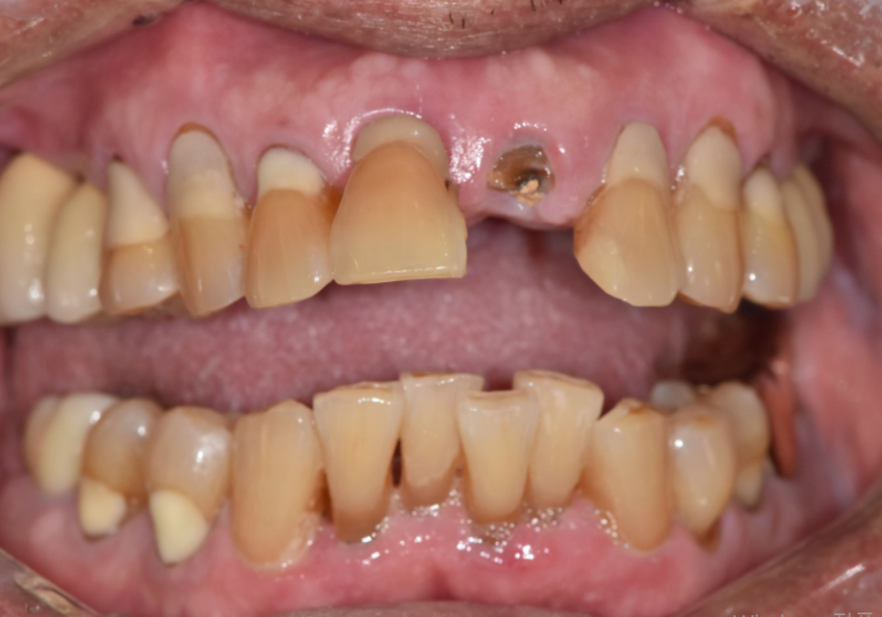 상일동역 치과 앞니 임플란트 기간 때문에 망설이신다면 꼭 보세요. 관련 이미지 2