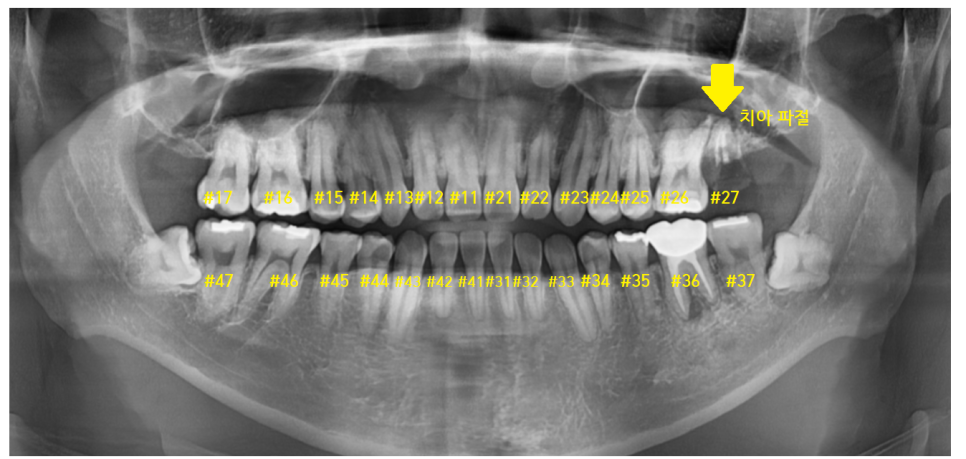 암사동 치과 임플란트 꼭 안 해도 되는 경우 궁금증 해결해 드려요 관련 이미지 6