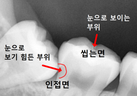 고덕동 사랑니 매복 발치, 안 아픈데 꼭 빼야 하나요? 관련 이미지 8