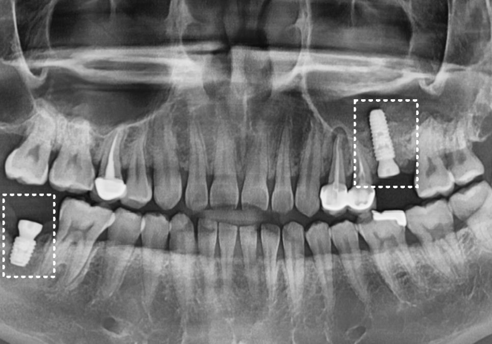 어금니 구멍, 충치 솔직하게 말씀드립니다. 치과 공포증으로 미루신 분들 필독 관련 이미지 11