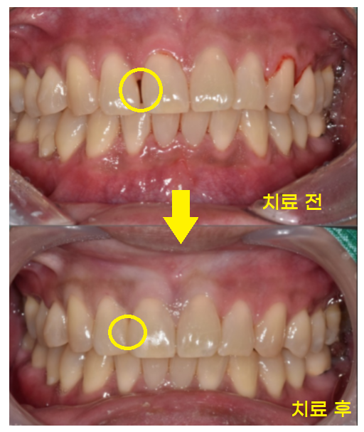앞니 레진 변색으로 무삭제 라미네이트 진행했습니다. 관련 이미지 3