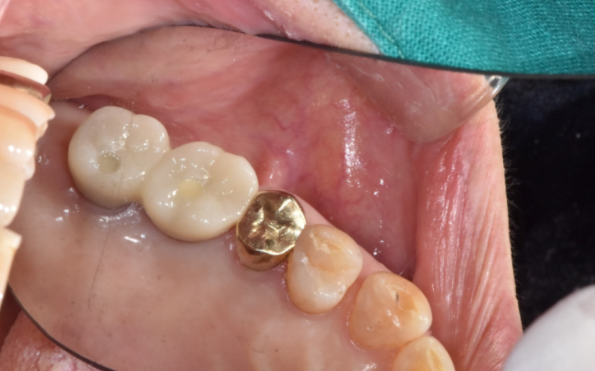 치아 크라운 빠짐 살릴 수 없을 때 강일역 임플란트 관련 이미지 9