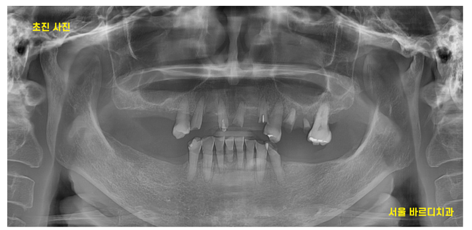 고덕역 치과 위아래 전체 임플란트 디지털을 사용하는 이유? 관련 이미지 2