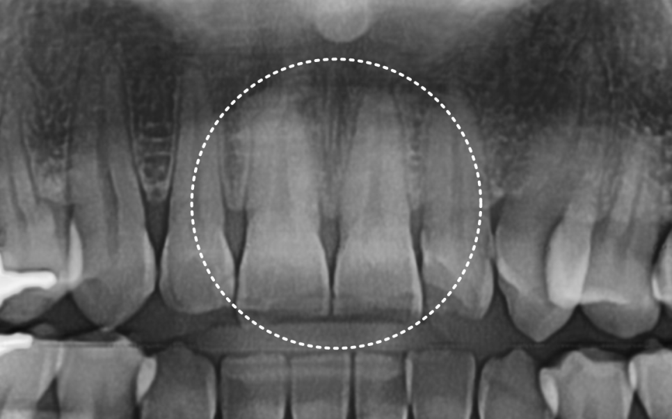 앞니 깨졌을 때, 치아 파절 실비 가능한가요? 관련 이미지 3