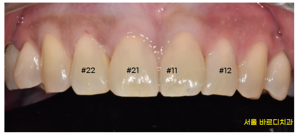 고덕 그라시움 치과 벌어진 앞니 메꾸기 당일 레진으로 치료했습니다. 관련 이미지 5