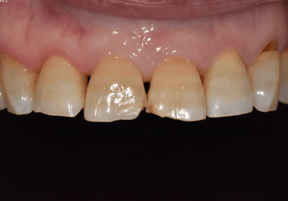 앞니 끝부분 깨짐, 다듬기, 레진, 라미네이트? 어떤 치료가 나에게 적합할까? 관련 이미지 1