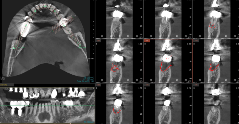 천호동 치과 무절개 임플란트 비교하고 결정하세요 관련 이미지 5