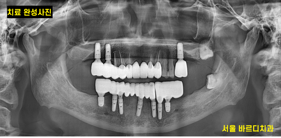 외국인 치과 진료 하악 전체 임플란트 7개 심어 12개 치아 만들기 관련 이미지 13