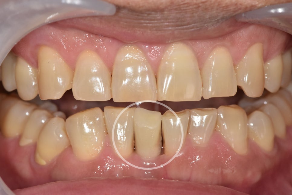 My Teeth Are Shaking So Much That Eating Is Uncomfortable—Is It Okay to Just Leave Them Alone? image 13
