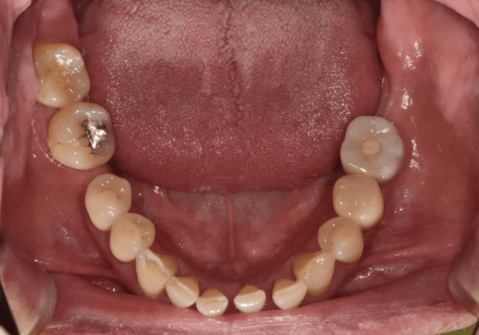 발치 후 빈 공간, 이 빼고 오래 냅두면 이렇게 됩니다. 관련 이미지 4