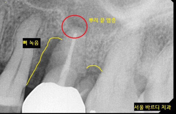 미사역 임플란트 상악동염으로 치아를 발치한 사연 관련 이미지 4