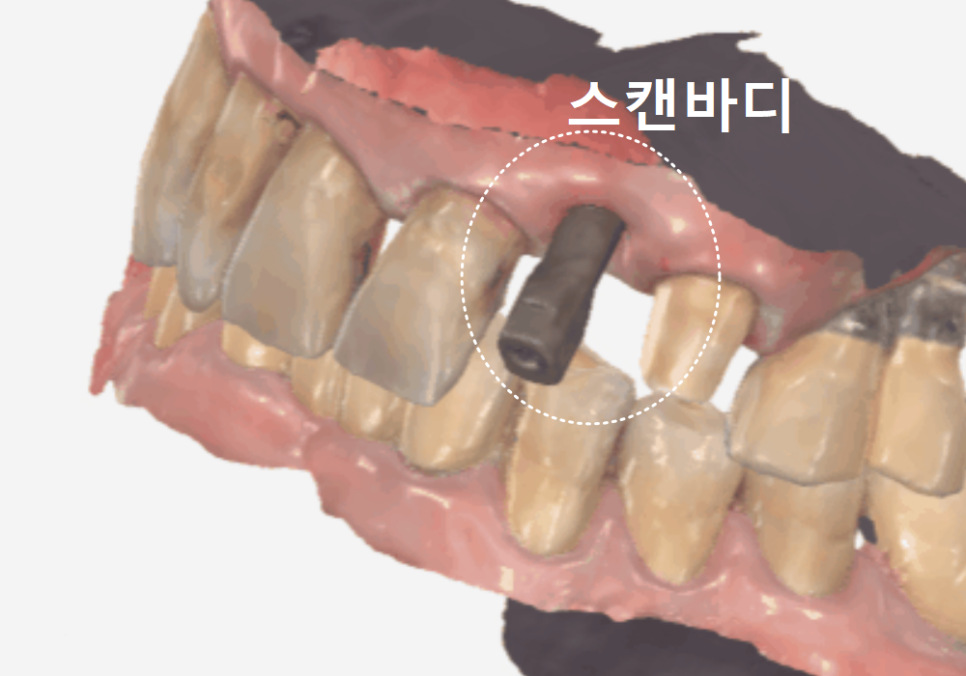 대문니 빠짐, 앞니 빠졌을 때 브릿지와 임플란트 중 나에게 맞는 선택은? 관련 이미지 14