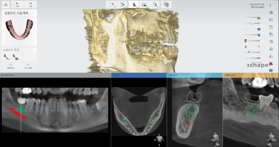 고덕동 치과 임플란트 거부감이 있었지만 네비게이션 수술법으로 해결했습니다. 관련 이미지 7