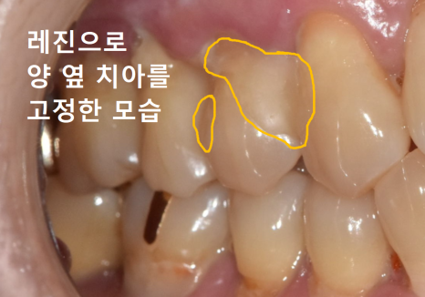 Gangil-dong Molar Implant, "It’s Loose—Can’t You Just Bond It with Resin?" image 2