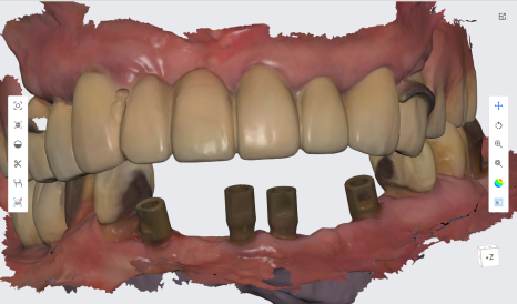 네비게이션 임플란트가 왜 좋다고 그러는거죠? (feat.13가지 장점) 관련 이미지 16