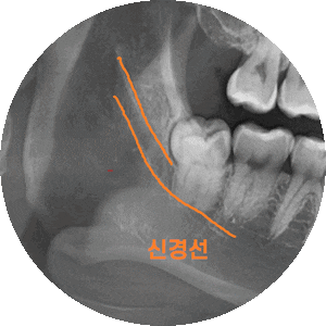 상일동 치과 매복 사랑니 발치 비용 정리해보았습니다!! 관련 이미지 1