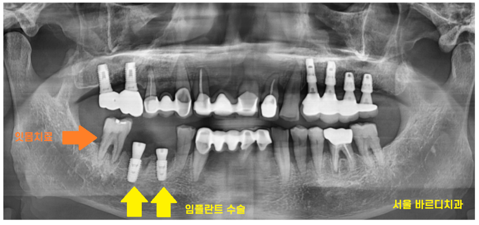 하남시청치과 치아 욱신거림 임플란트로 치료해드렸습니다. 관련 이미지 7