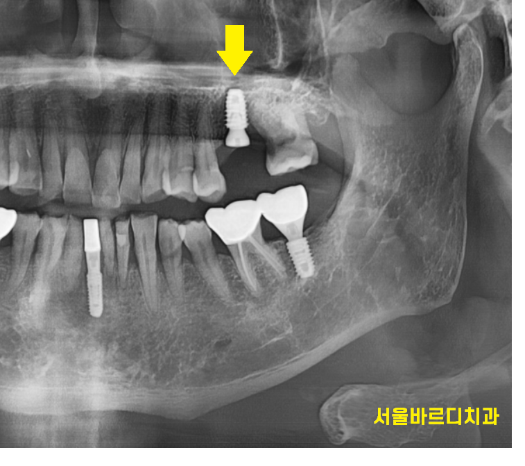 하남 치과 임플란트 질문 폭격기를 환영합니다. 결정은 자유롭게! 관련 이미지 2