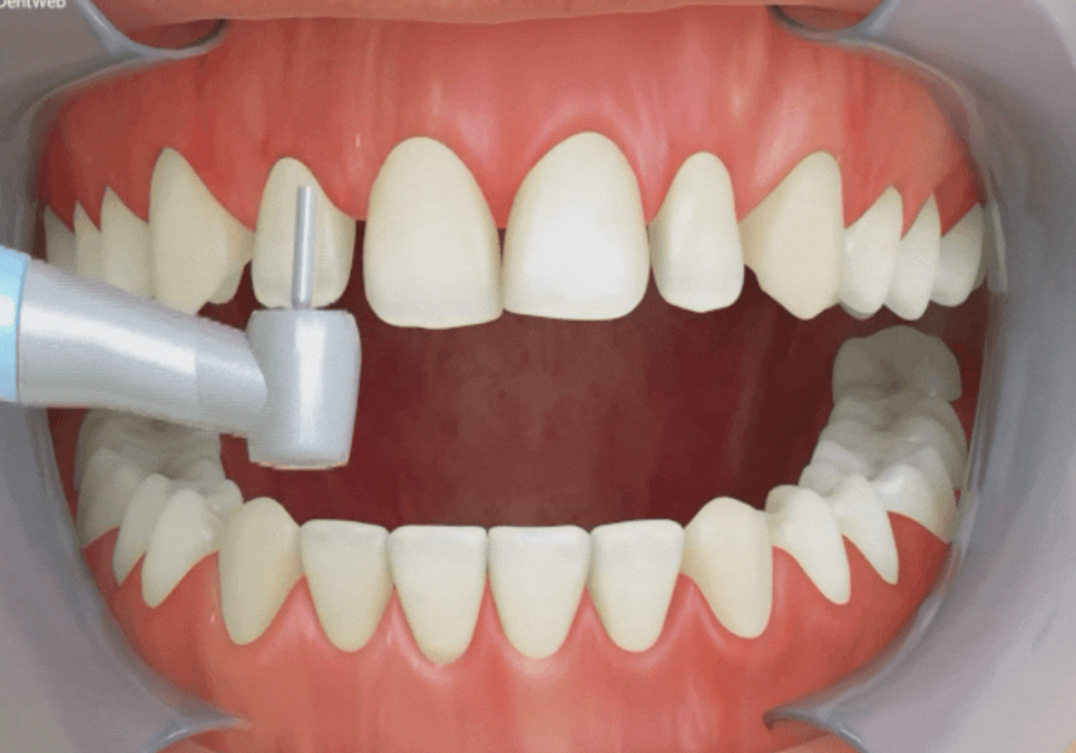 고덕동 치과 누런 이, 앞니 사이 틈, 잘못된 관리 때문일까? 관련 이미지 12