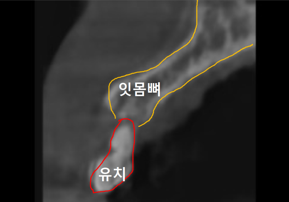 흔들리는 성인 잔존 유치, 50년 만에 송곳니 임플란트 하게 된 사연 관련 이미지 7