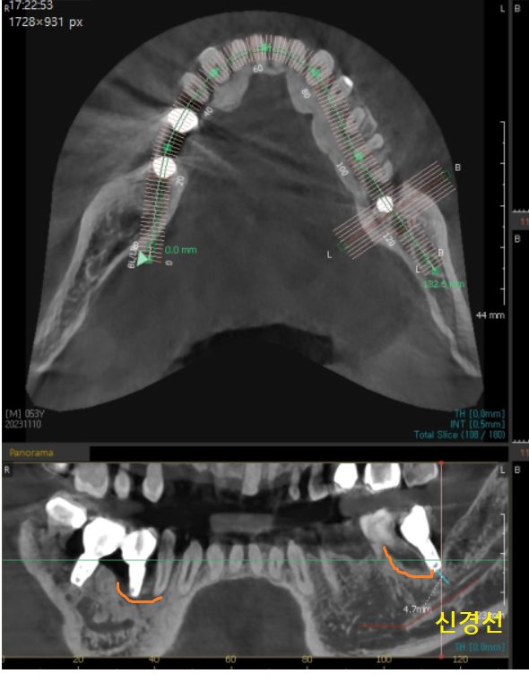 고덕동 치과 임플란트 뼈이식 꼭 해야하는건가요? 관련 이미지 6