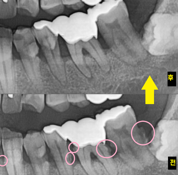 강일동 치과추천 어금니 시림 방치하지마세요 발치하고 임플란트 할 수 있습니다. 관련 이미지 8