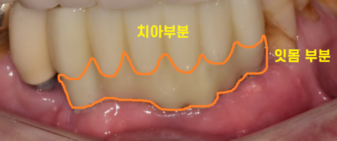 강동구 치과 앞니 흔들림 임플란트 케이스 관련 이미지 10