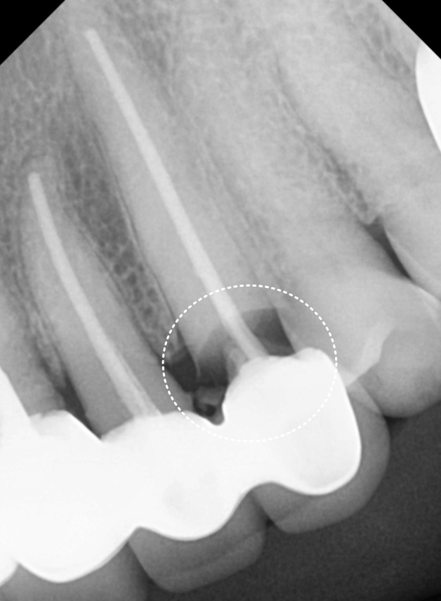 앞니 고름, 잇몸약을 먹어도 왜 염증이 가라앉지 않을까요? 관련 이미지 7