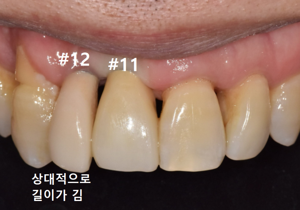 앞니 임플란트, 원내 기공소의 중요성을 아시나요? 관련 이미지 16