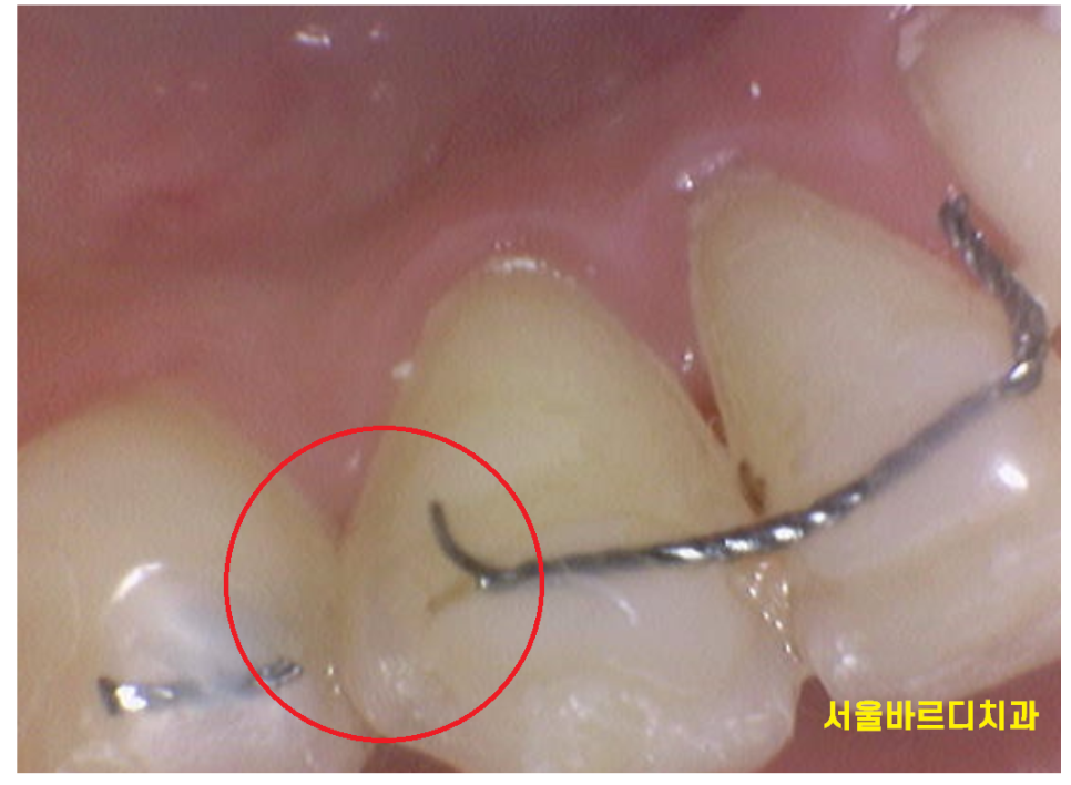 강동구 치아교정 병원에서 물어봐야할 필수 질문 4가지 관련 이미지 4