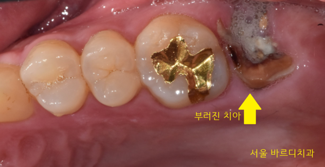 감일동 치과 첫번째 임플란트 시작이 중요합니다. 관련 이미지 3