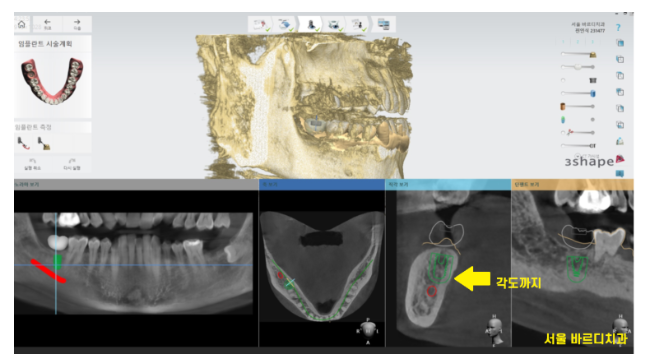 하남시청치과 내비게이션 임플란트 왜 좋다는거죠? 관련 이미지 4