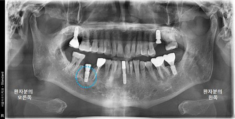서울바르디치과 상하악 대구치 네비게이션 임플란트 치료증례 #4 관련 이미지 11
