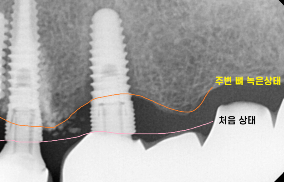 임플란트 충치 걱정? 잇몸을 먼저 생각하세요 관련 이미지 3