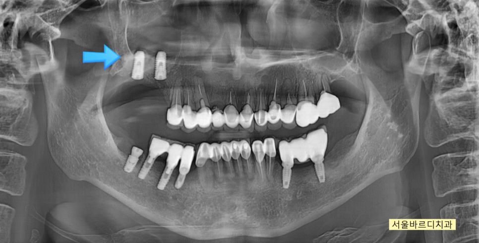 위아래 임플란트 동시에 하여 치료기간 단축하기 관련 이미지 4